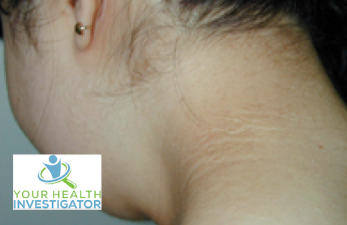 Acanthosis Nigricans Groin